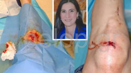 Πάτρα: Αγρια επίθεση κουκουλοφόρων σε μητέρα τριών παιδιών -Τη χτύπησαν, τη λήστεψαν και την πέταξαν σε χαντάκι