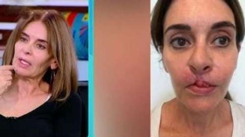 Συγκλονίζει η Κατερίνα Πλουμιδάκη: "Στις 40 εγχειρήσεις θα είμαι καλύτερα" - Όσα αποκάλυψε η συγγραφέας για τις επεμβάσεις στα χείλη