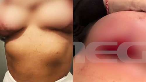 Σε απόγνωση 30χρονη - Πλαστικός χειρουργός τετραγώνισε το στήθος της - "Σαν να με έχει σφάξει χασάπης" [βίντεο]
